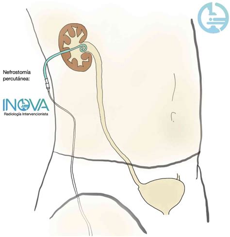 Ilustración de la colocación de un catéter de nefrostomía percutánea.