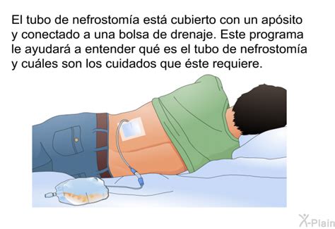 Infografía detallando los pasos para el cuidado de un catéter de nefrostomía.