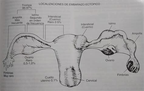 Diagrama que muestra las diferentes localizaciones posibles de un embarazo ectópico: trompa de Falopio, ovario, cuello uterino, abdomen.
