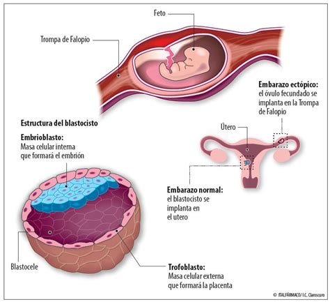 Infografía que compara visualmente un embarazo normal implantado en el útero con un embarazo ectópico en la trompa de Falopio.