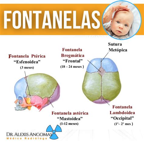 Infografía sobre las fontanelas y deformaciones craneales del recién nacido
