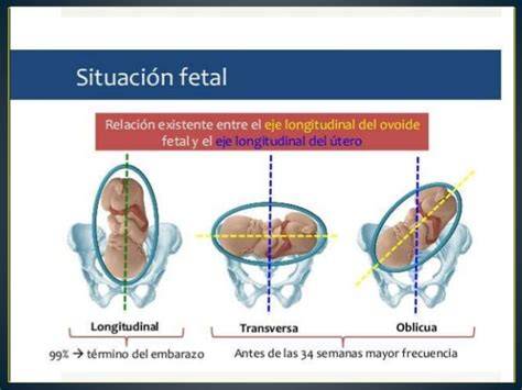 Esquema de las diferentes situaciones fetales: longitudinal, transversa y oblicua.