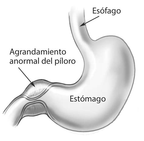 Diagrama anatómico del sistema digestivo del bebé, señalando el píloro y el esfínter esofágico inferior para explicar la estenosis pilórica y el RGE.