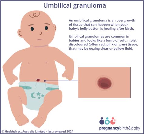 Ilustración de un granuloma umbilical