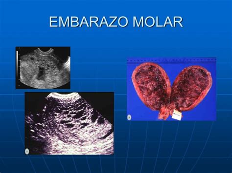 Ecografía pélvica mostrando un embarazo molar