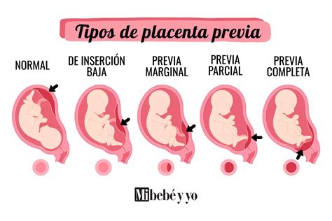 Diagrama de los diferentes tipos de placenta previa (baja, marginal, oclusiva parcial, oclusiva total)