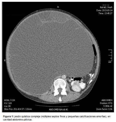 Imagen de RM de un tumor mucinoso de ovario asociado a teratoma maduro
