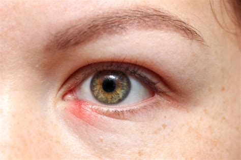 Foto de cerca de un ojo de niño con blefaritis, mostrando enrojecimiento y costras en las pestañas