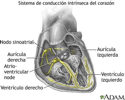 diagrama del sistema de conducción cardíaco afectado en el bloqueo cardíaco congénito