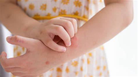 Gráfico comparativo de reducción de síntomas de urticaria en niños con rupatadina