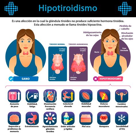 infografía con los síntomas de hipertiroidismo e hipotiroidismo