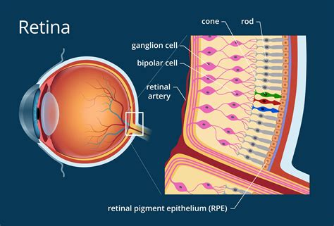 Esquema de la retina mostrando la mácula y las áreas afectadas por la enfermedad de Stargardt