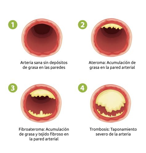 Gráfica que ilustra el inicio temprano de la aterosclerosis en la infancia.