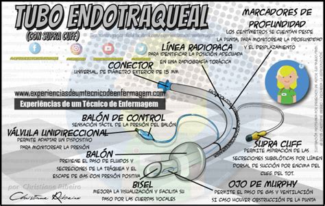 Esquema de un intercambiador de tubo endotraqueal insertado en un tubo endotraqueal
