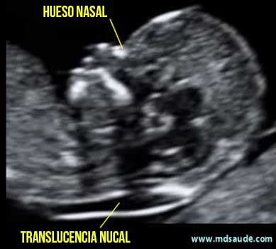 diagrama de translucencia nucal en ecografía