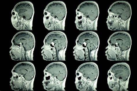 imagen de resonancia magnética fetal del cerebro