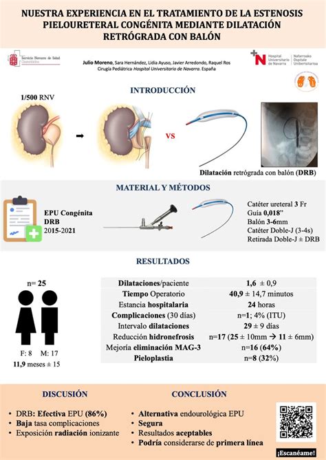 Diagrama o esquema del procedimiento de dilatación endourológica con balón para estenosis pieloureteral