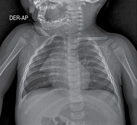 Radiografía de tórax de un recién nacido con patrón de vidrio esmerilado
