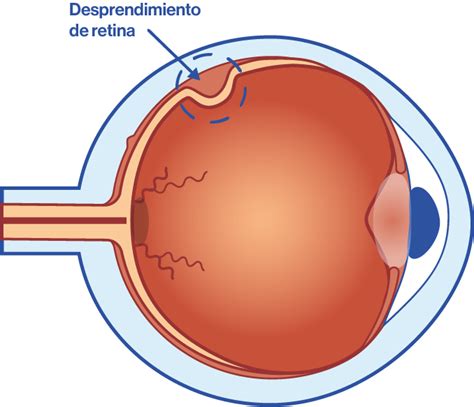 Infografía o esquema sobre el desprendimiento de retina y sus riesgos para un boxeador