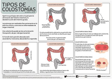 Diagrama de la anatomía del colon mostrando la ubicación de una colostomía transversa
