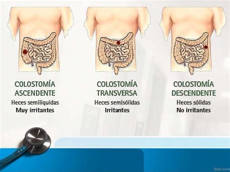 Esquema de las ubicaciones de la colostomía ascendente, transversa, descendente y sigmoidea