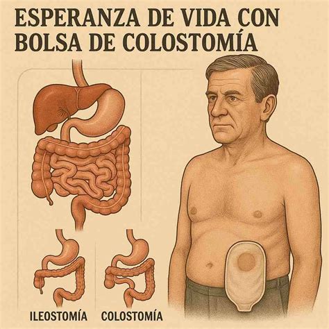 Imagen de un bebé con una bolsa de colostomía neonatal correctamente colocada