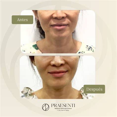 Infografía: antes y después de tratamientos estéticos (bioestimulación, blefaroplastia)