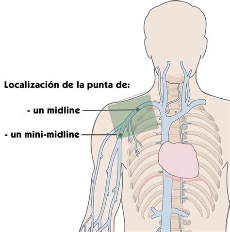 Esquema: Anatomía de la inserción de un catéter Midline en el brazo del neonato