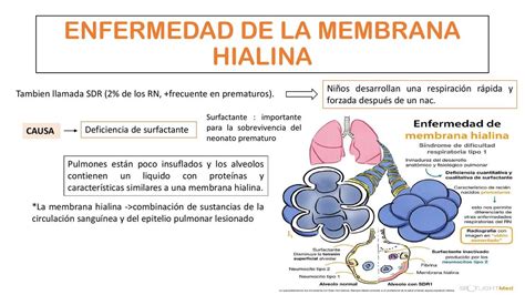 Diagrama esquemático que ilustra la patogénesis de la Enfermedad de la Membrana Hialina, mostrando la deficiencia de surfactante y el colapso alveolar.