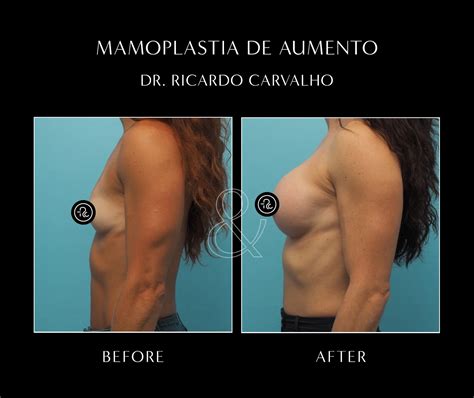 Infografía comparativa de las técnicas de mamoplastia: aumento, reducción y mastopexia