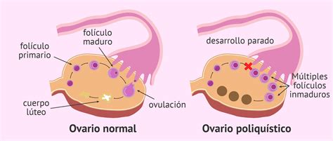 Esquema de ovarios sanos vs. ovarios con síndrome de ovario poliquístico con folículos inmaduros