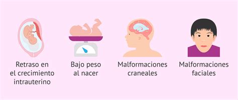 Ilustración de las características faciales asociadas al síndrome de Möebius.