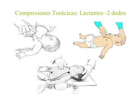 Ilustración de la técnica de compresiones torácicas en lactantes y niños