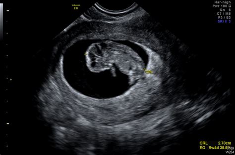 Sonograma de un feto en el primer trimestre de embarazo