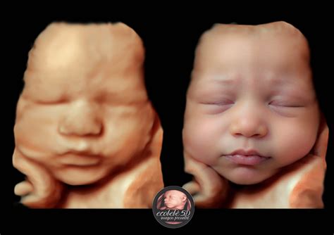 Imagen de un bebé en ecografía 5D con expresión facial realista