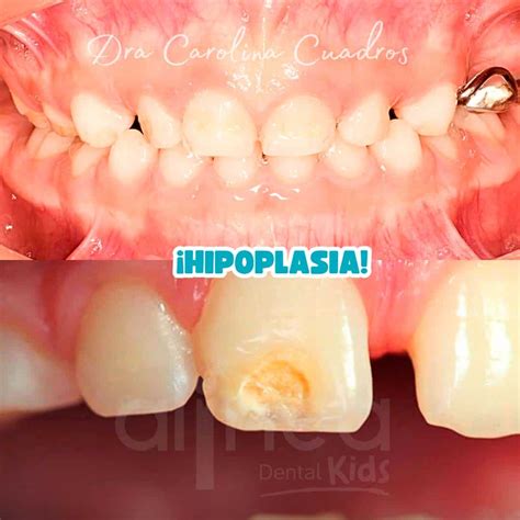 infografía sobre la prevalencia de hipoplasia dental en niños