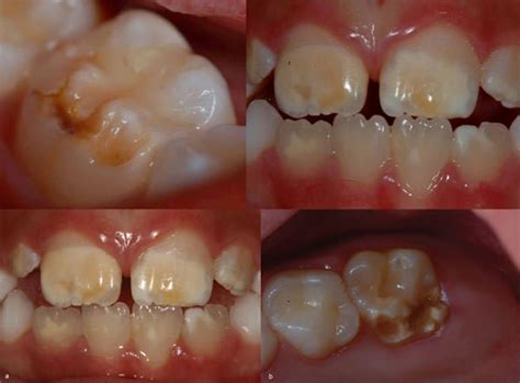 fotos de dientes infantiles con signos de hipoplasia (manchas, surcos)