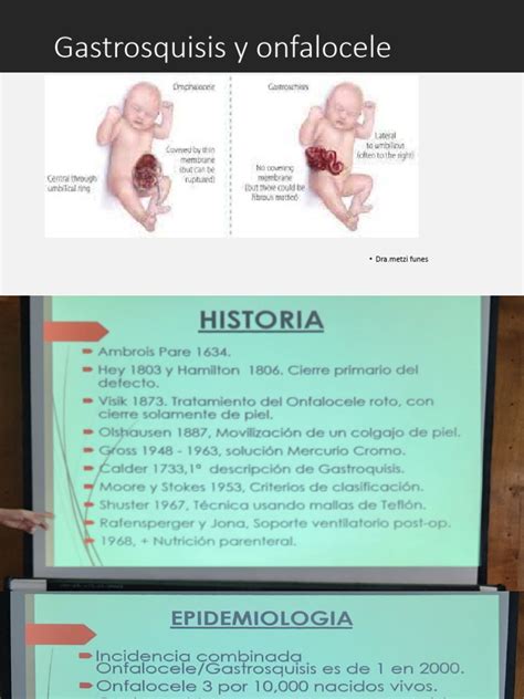 Esquema que ilustra las características clínicas del SBW, incluyendo macroglosia, onfalocele y crecimiento lateralizado.
