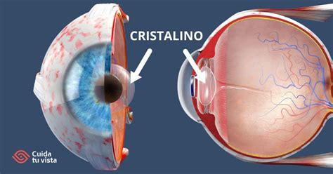 Esquema anatómico del ojo humano mostrando la ubicación del cristalino y la diferencia entre un cristalino sano y uno con catarata (opacidad).