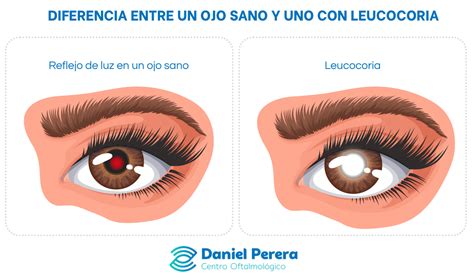 Infografía comparativa: efecto 