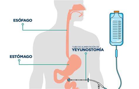 Esquema de una enterostomía en neonato