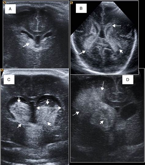 imágenes de ecografía transfontanelar mostrando diferentes grados de hemorragia intraventricular según la clasificación de Papile