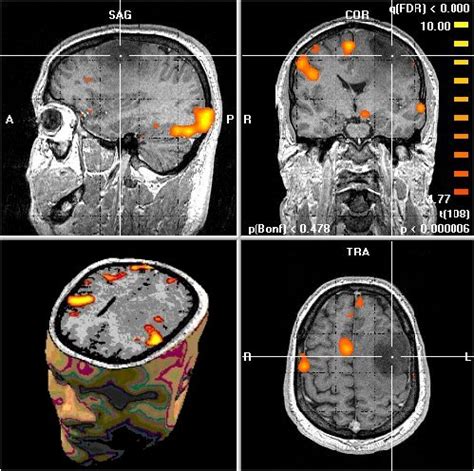 Mapa de activación cerebral de fMRI destacando áreas de recompensa