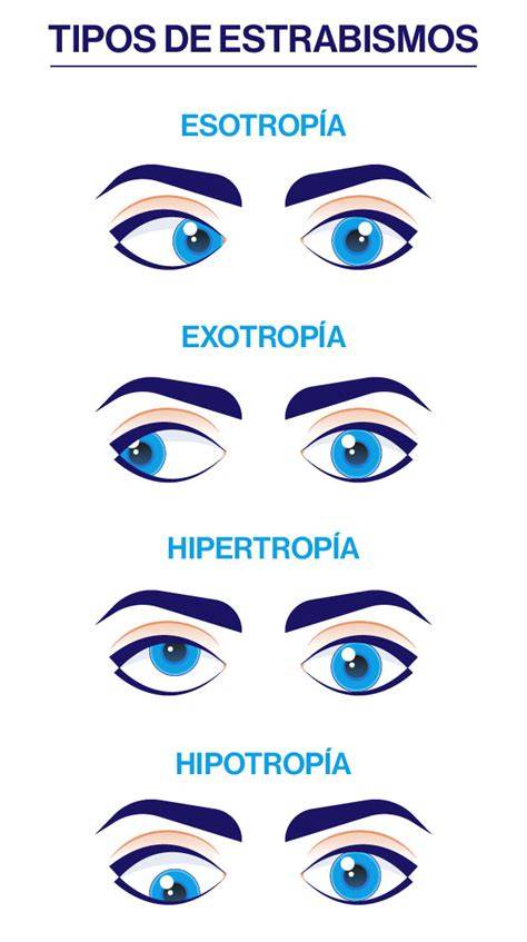 Imágenes comparativas de pseudoendotropia y estrabismo real para ilustrar la diferencia en los reflejos corneales