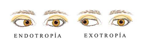 Serie de fotos de niños con diferentes tipos de estrabismo (endotropia, exotropia) para ilustrar las desviaciones oculares