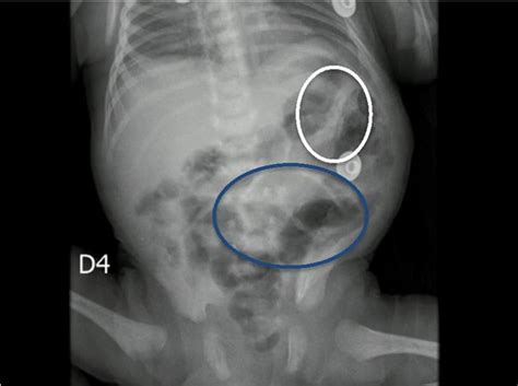radiografía abdominal de un recién nacido mostrando signos de enterocolitis necrotizante