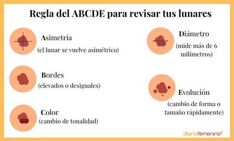 Infografía de la regla ABCDE para identificar lunares sospechosos
