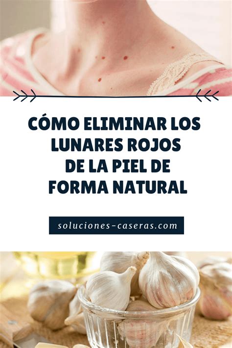 Señal de prohibido con métodos caseros para eliminar lunares