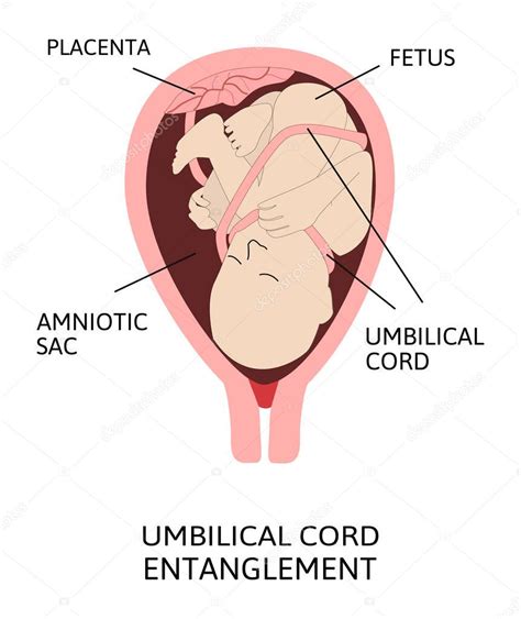 Ilustración de la placenta siendo expulsada del útero
