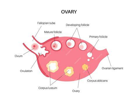 Esquema de la anatomía del ovario con la formación de quistes